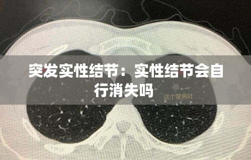 突发实性结节：实性结节会自行消失吗 