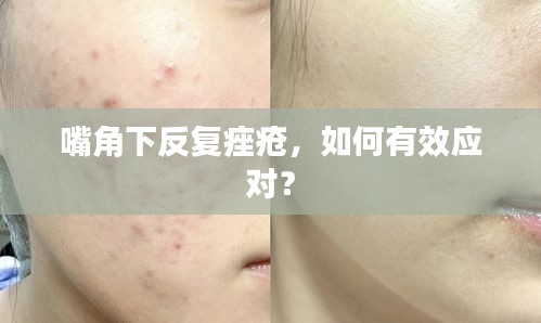 嘴角下反复痤疮，如何有效应对？