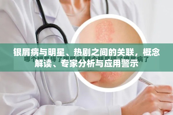 银屑病与明星、热剧之间的关联，概念解读、专家分析与应用警示